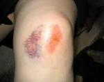 Ушиб коленного сустава при падении лечение симптомы полное описание травмы