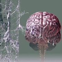 Антиагреганты эффективно замедляют развитие болезни Альцгеймера