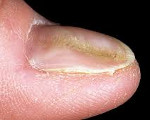 Деформация ногтя на большом пальце руки