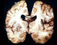 Аспергиллез головного мозга