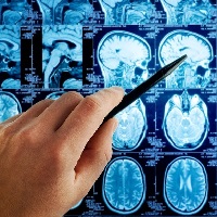 Отсутствие лечения инсульта не приводит к увеличению участка поражения мозга
