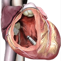 Кардиостимулятор без электродов имплантируется прямо в сердце