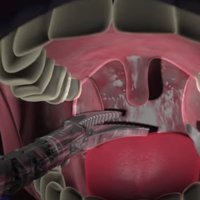 Робот-хирург научился удалять неоперабельные опухоли горла