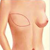 Реконструкция женской груди