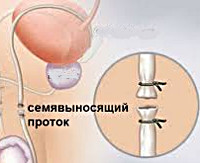 Процедура Вазэктомия (стерилизация у мужчин)
