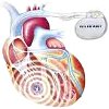 Имплантация двухкамерного кардиовертер-дефибриллятора (ИКД)