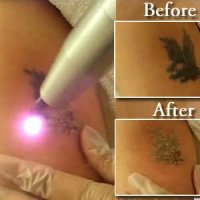 Избавление от татуировки чревато развитием рака кожи