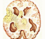 Туберкулезный менингит