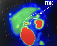 Врожденный гиперинсулинизм