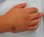 Перелом кисти руки: симптомы и лечение