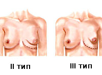Тубулярная грудь