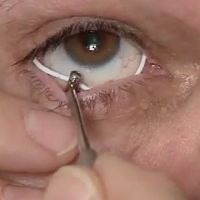 Силиконовое кольцо поможет забывчивым пациентам с заболеваниями глаз