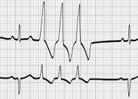 Экстрасистолия сердца что это такое