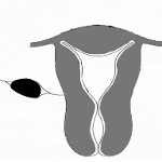 Межсвязочная фиброма матки