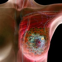 Разработана новая модель расчета рисков рака груди