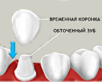 Временный коронки на обточенных зубах Временный коронки на обточенных зубах