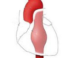 Аневризма нисходящего отдела грудной аорты
