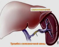 Тромбоз селезеночной вены