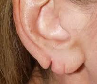 Отсутствие уха и/или мочки
