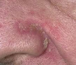 Себорейный дерматит на лице код по мкб thumbnail