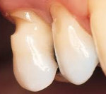 Клиновидный дефект зубов диагностика лечение thumbnail