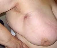 Лечение жирового некроза молочной железы thumbnail