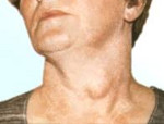 Узловой зоб щитовидной железы лечение противопоказания thumbnail