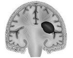 Развивающуюся внутримозговая гематома при кровоизлиянии в мозг thumbnail