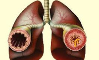 Заболевания лёгких (бронхит, пневмония, бронхиальная астма) thumbnail