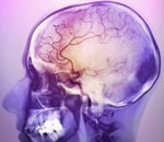 Хроническая ишемия головного мозга с цефалгическим синдромом thumbnail