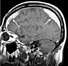 Субдуральная гематома головного мозга при тяжелой ушибе thumbnail