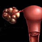 Текалютеиновая киста яичника беременность thumbnail