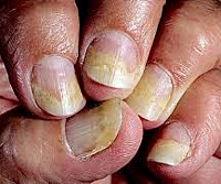 Онихолизис болезнь ногтей от чего она thumbnail
