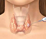 Лечение кист и узлов щитовидной железы thumbnail