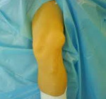Врожденный вывих голени в коленном суставе thumbnail