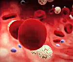 Наследственная микросфероцитарная анемия мкб thumbnail