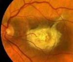 Новое при лечении абиотрофии сетчатки глаза thumbnail