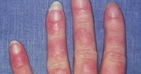 Генерализованные высыпания на коже алопеция волчаночноподобный синдром thumbnail