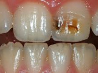 Заболевания твердых тканей зуба 
