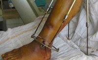 Остеомиелит после перелома ноги лечение thumbnail