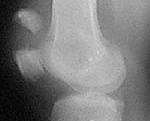 Перелом коленной чашечки у пожилых сроки лечения thumbnail