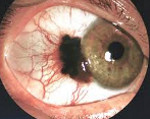 Результаты лечения меланомы глаза thumbnail