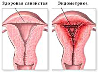 При эндометриозе может быть головокружение thumbnail