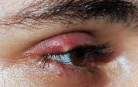 Наружный ячмень глаза клиника диагностика неотложная помощь thumbnail