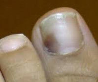 Что делать при ушибе ногтя и как избежать отслоения thumbnail