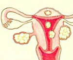Лечение миома тела матки thumbnail