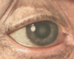 Факосклероз сетчатки глаза что это такое thumbnail