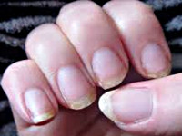 Ломкость ногтей при анемии thumbnail