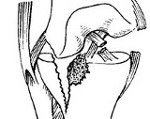 Многооскольчатый внутрисуставной перелом большеберцовой кости thumbnail