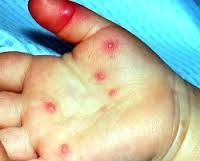 Энтеровирусная инфекция у ребенка 3 года thumbnail